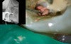 Endodontic management of higly curved messio-buccal canal
