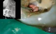 Endodontic management of higly curved messio-buccal canal
