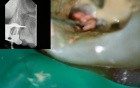 Endodontic management of higly curved messio-buccal canal
