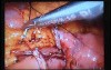 Jejunal Gastrointestinal Stromal tumor (GIST) (32 of 86)