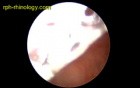 Chicken Bone In The Esophagus