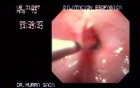 Esophageal Stricture Due To Ingestion Of Corrosive Substance - Endoscopy