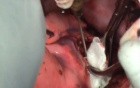 Echinococcosis hidatid cysts