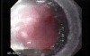 Alcoholic Cirrhosis - Banding of the Varix, Part 2
