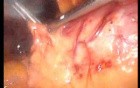 Gastrointestinal Stromal Tumor - GIST (21 of 65)