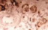 Endoscopy of Scirrhous Gastric Carcinoma involving the entire Fundus, Body and the Antrum (9 of 47)