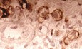 Endoscopy of Scirrhous Gastric Carcinoma involving the entire Fundus, Body and the Antrum (9 of 47)