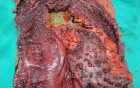 Multiple Rectal Ulcers (94 of 110)