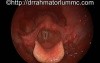 Parkinson's Disease - Laryngeal Tremors