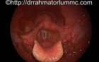 Parkinson's Disease - Laryngeal Tremors