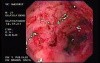 Radiation Proctosigmoiditis (3 of 14)