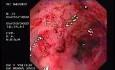 Radiation Proctosigmoiditis (3 of 14)