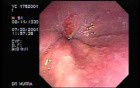 Barrett's Esophagus 