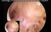 Middle Ear Cavity-The Hypotympanum