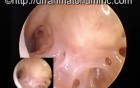 Middle Ear Cavity-The Hypotympanum