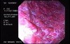 Severe Case Of Ulcerative Colitis (1 of 6)