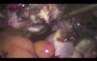 Suprecervical Laparoscopic Hysterectomy (SLH)
