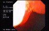 Duodenal B Cell Lymphoma (5 of 7)