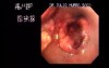 Esophageal Squamous Cell Carcinoma - case 1