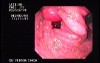 Familial Adenomatous Polyposis of the Colon (10 of 29)