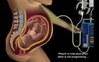 Effects of Pitocin on Uterine Contractions