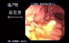 Gastroscopy