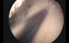 Cystolithotripsy - Removal of Bladder Calculi 