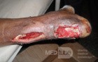 Necrotizing Fascitis At The Achill's Tendon In Diabetic Patient
