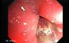 Rectal Stalked Polyp (6 of 7)