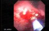 Upper Gastrointestinal Tract - Bleeding (4 of 7)