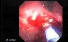 Upper Gastrointestinal Tract - Bleeding (4 of 7)