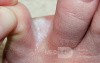 Interdigital Tinea pedis