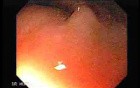 Gastrointestinal Stromal Tumor - GIST (1 of 13)
