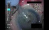 Cataract Surgery X - Part 2