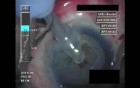 Cataract Surgery X - Part 2