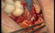 Intra-Grafting Procedures (1/2)
