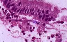 Histopathology of Amebiasis