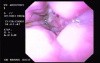 Hemorrhage due status post rubber band ligation of esophageal varices (2 of 25)