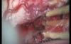 Cervical Intramedullary Astrocytoma - Posterior Approach