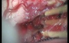 Cervical Intramedullary Astrocytoma - Posterior Approach