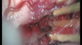 Cervical Intramedullary Astrocytoma - Posterior Approach