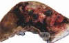 Gallbladder Adenocarcinoma and litiasis (4 of 13)