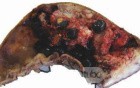 Gallbladder Adenocarcinoma and litiasis (4 of 13)