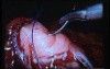 Jejunal Gastrointestinal Stromal tumor (GIST) (53 of 86)