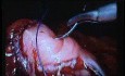 Jejunal Gastrointestinal Stromal tumor (GIST) (53 of 86)