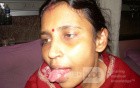 Tongue Cancer