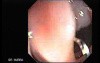 Colonoscopic Polypectomy (11 of 23)