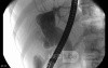Adenocarcinoma of the head of the Pancreas that infiltrates
 the wall of duodenum (10 of 10)