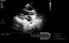Endocarditis - Mitral Valve Vegetation