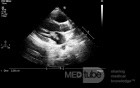 Endocarditis - Mitral Valve Vegetation